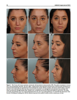 The Rhinoplasty Center Newport Beach CA Primary Rhinoplasty - Before and After Patient