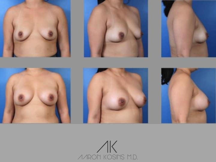 Slide121 - Newport Beach Breast Augmentation