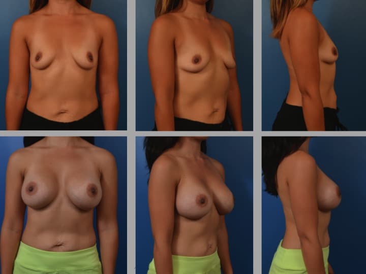 Slide14 - Newport Beach Breast Augmentation
