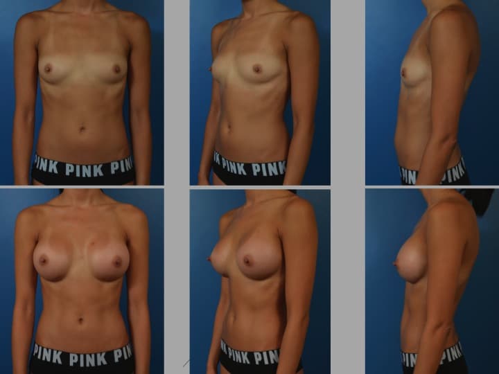 Slide18 - Newport Beach Breast Augmentation