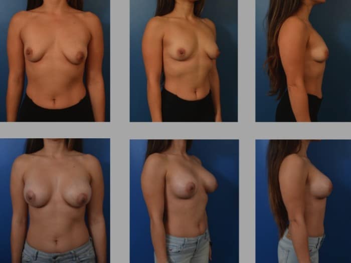 Slide2 5 700x525 - Newport Beach Breast Augmentation