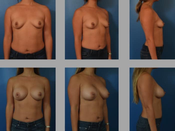 Slide218 700x525 - Newport Beach Breast Augmentation