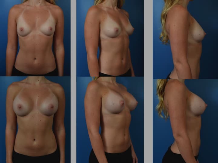 Slide68 - Newport Beach Breast Augmentation