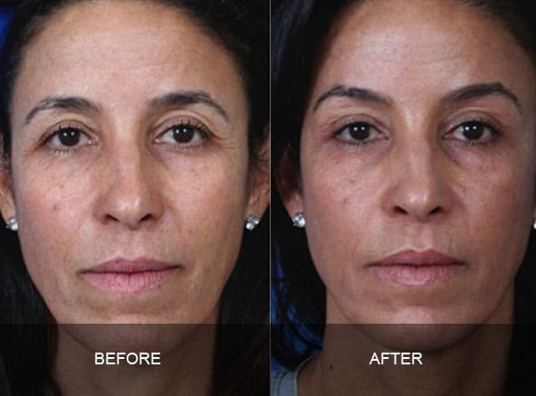 facial 3 - Facial Aging and Rejuvenation