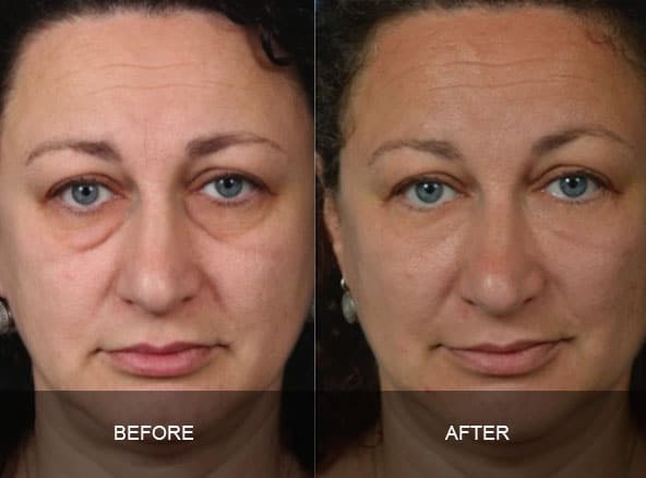 facial 5 - Facial Aging and Rejuvenation