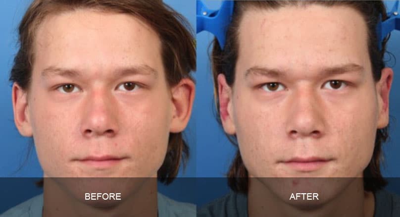facial 6 - Facial Aging and Rejuvenation