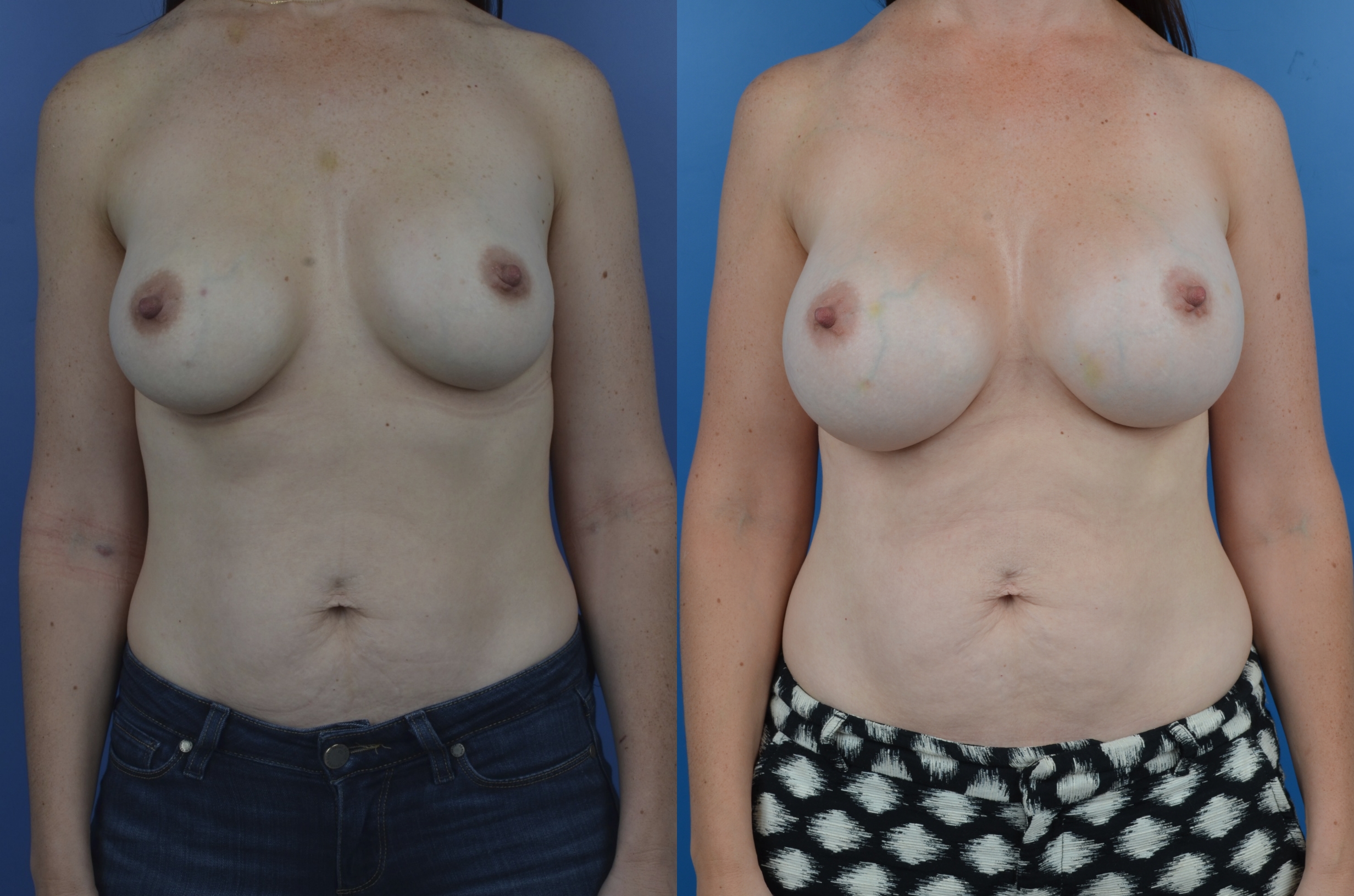 Slide301 - Newport Beach Breast Augmentation