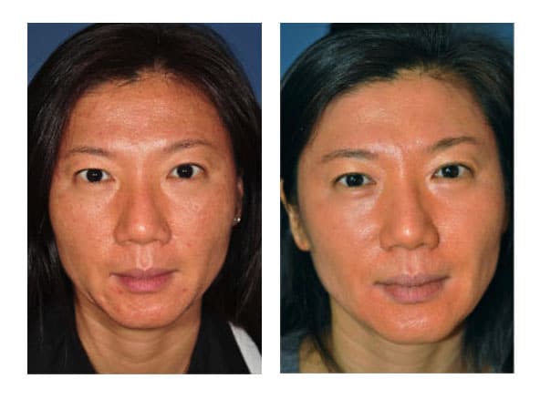 botox 1 - Botox and Fillers