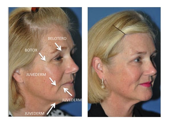 botox 2 - Botox and Fillers