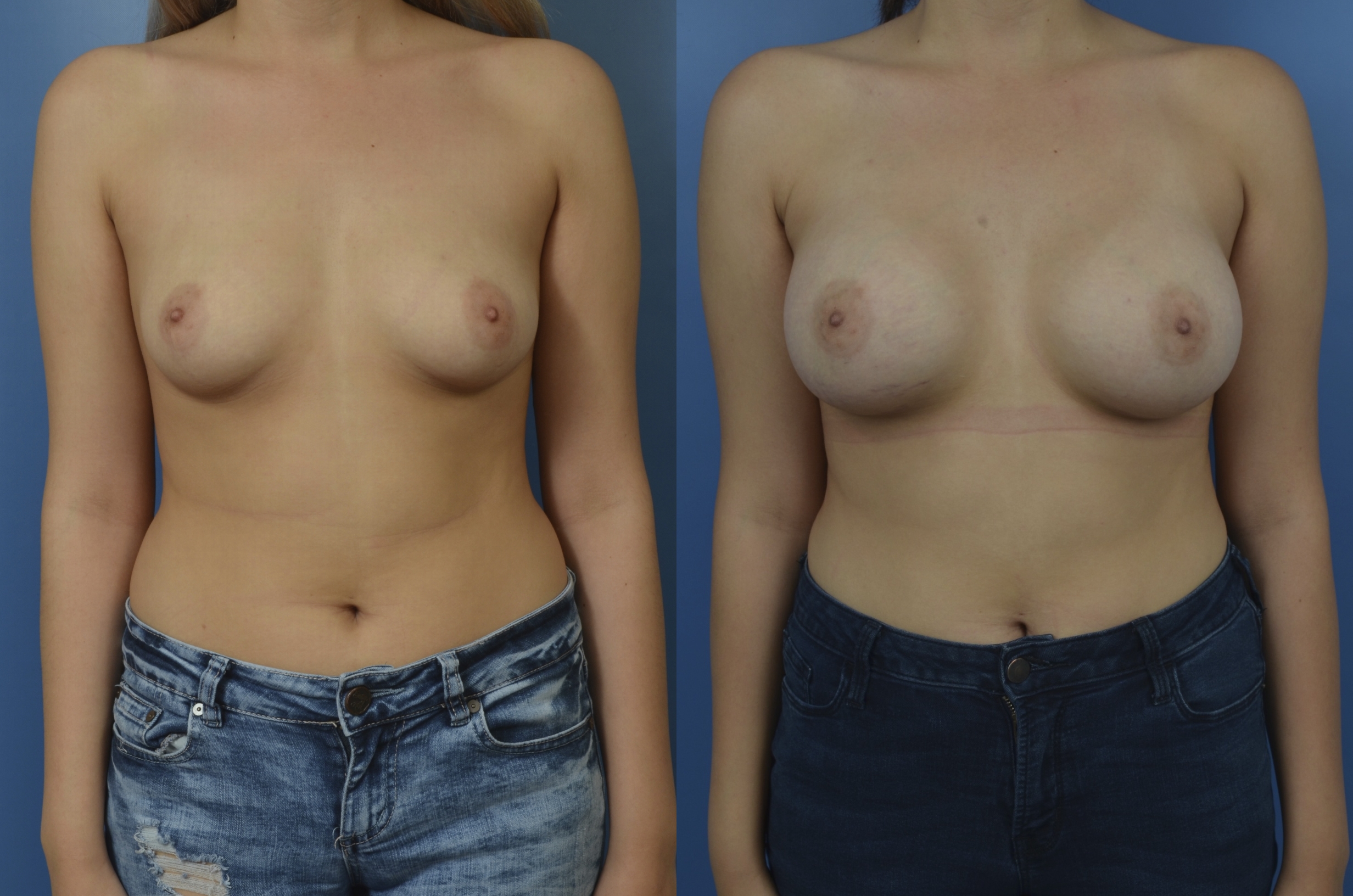 Slide 307 - Newport Beach Breast Augmentation
