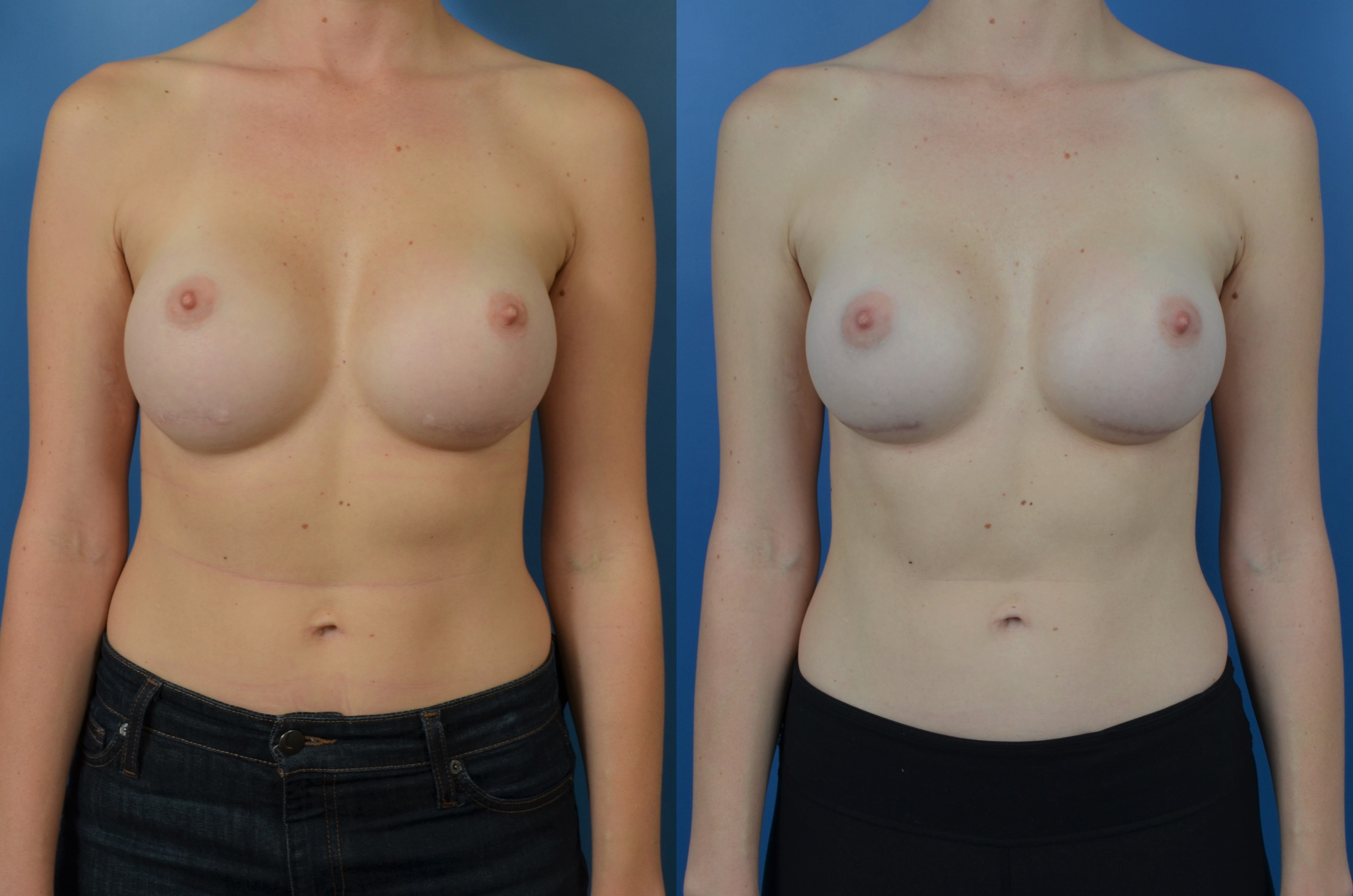 Slide306 - Newport Beach Breast Augmentation
