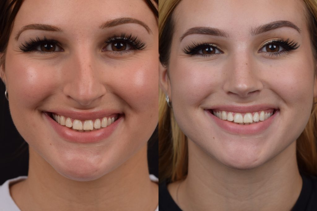 Preservation Rhinoplasty USA Dr. Aaron Kosins (949) 7210494